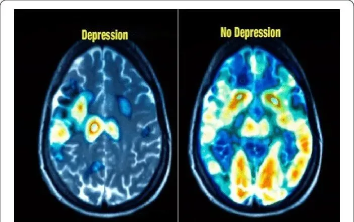 How Depression Affects the Brain